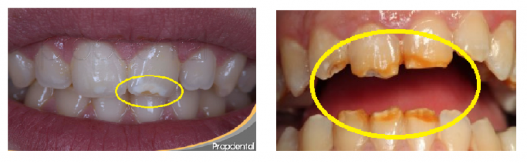 C Mo Saber Si Mi Hijo Tiene Hipoplasia Dental Dentilandia