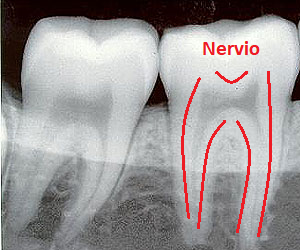 Radiografía dientes