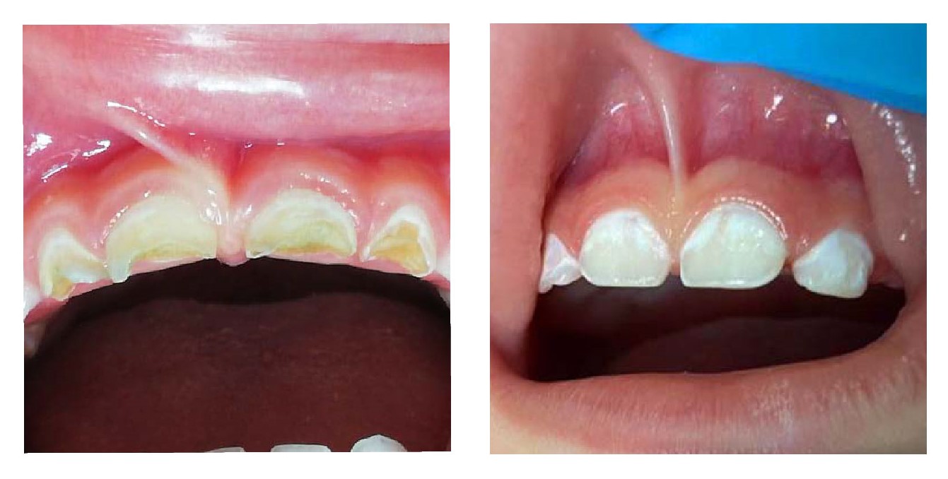 Caries dental en niños