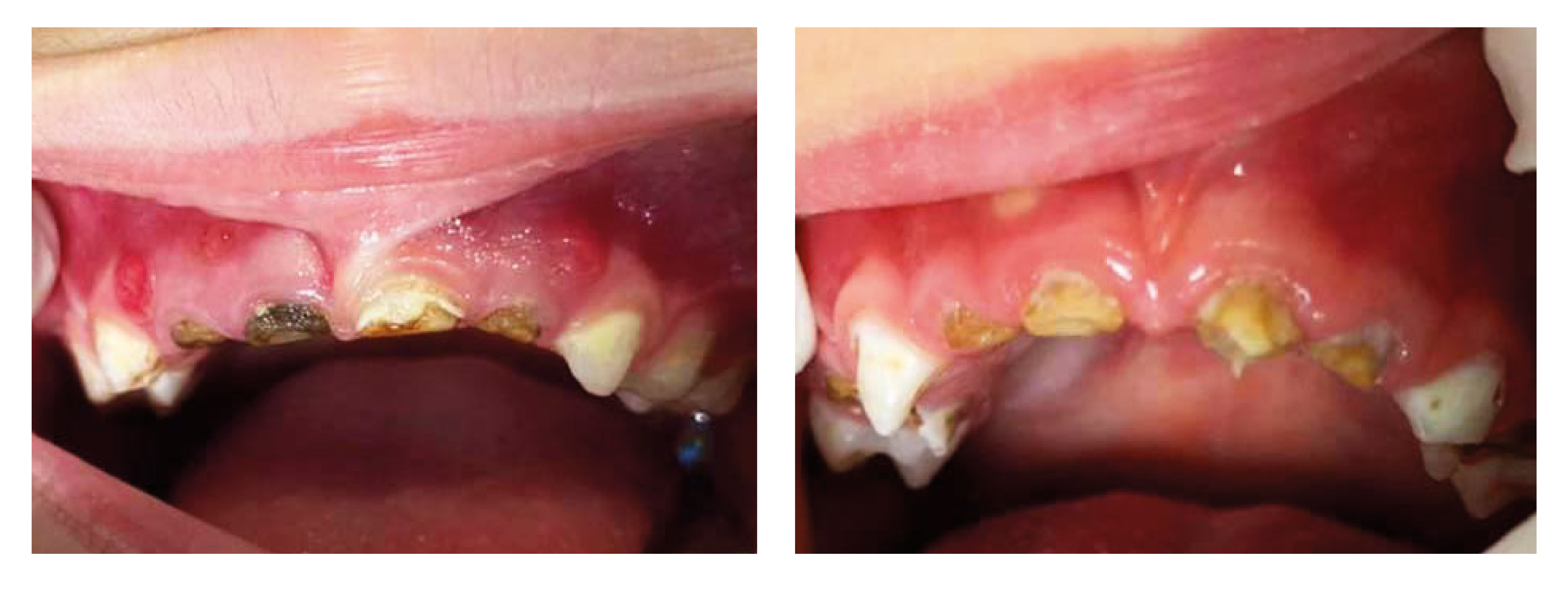 Caries de infancia temprana