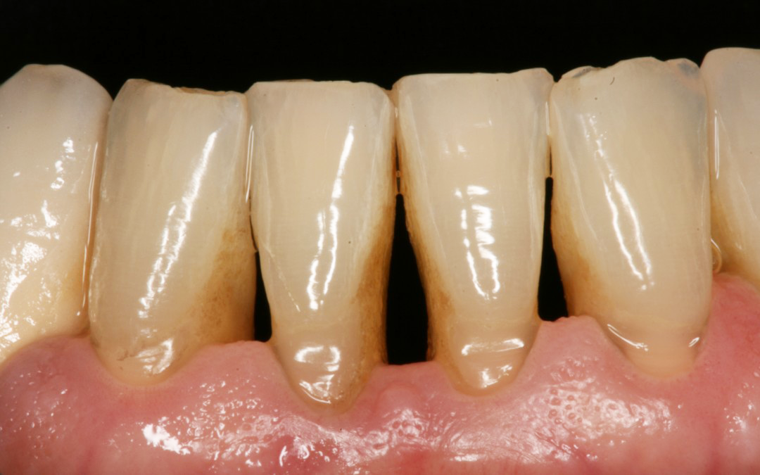 Periodontitis