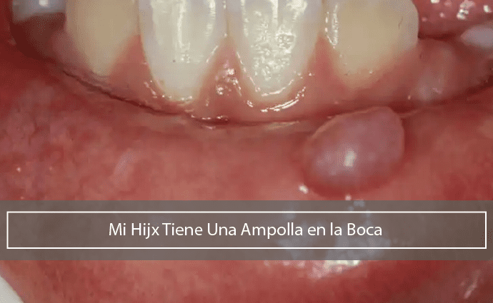 Mi Hij Tiene Una Ampolla En La Boca Dentilandia