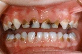Caries de infancia temprana | Odontología Infantil | Dentilandia Medellín