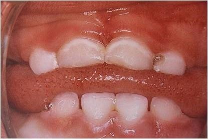 Manchas Blancas | Odontopediatría Medellín