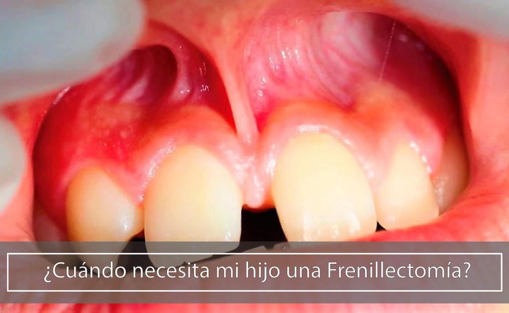 Frenillectomía