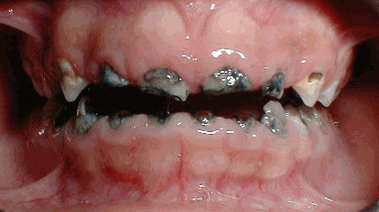 Por qué se Extraen Dientes de Leche