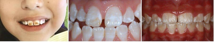 fluorosis causada por la ingesta de fluor