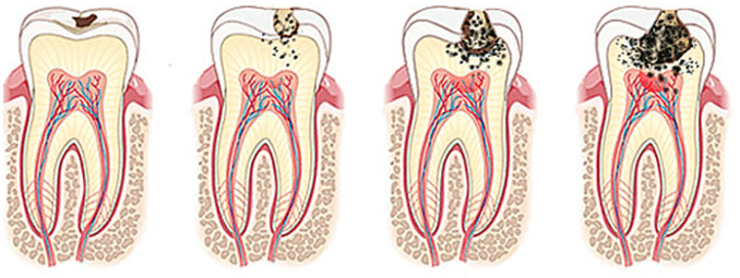 Progreso de la caries dental