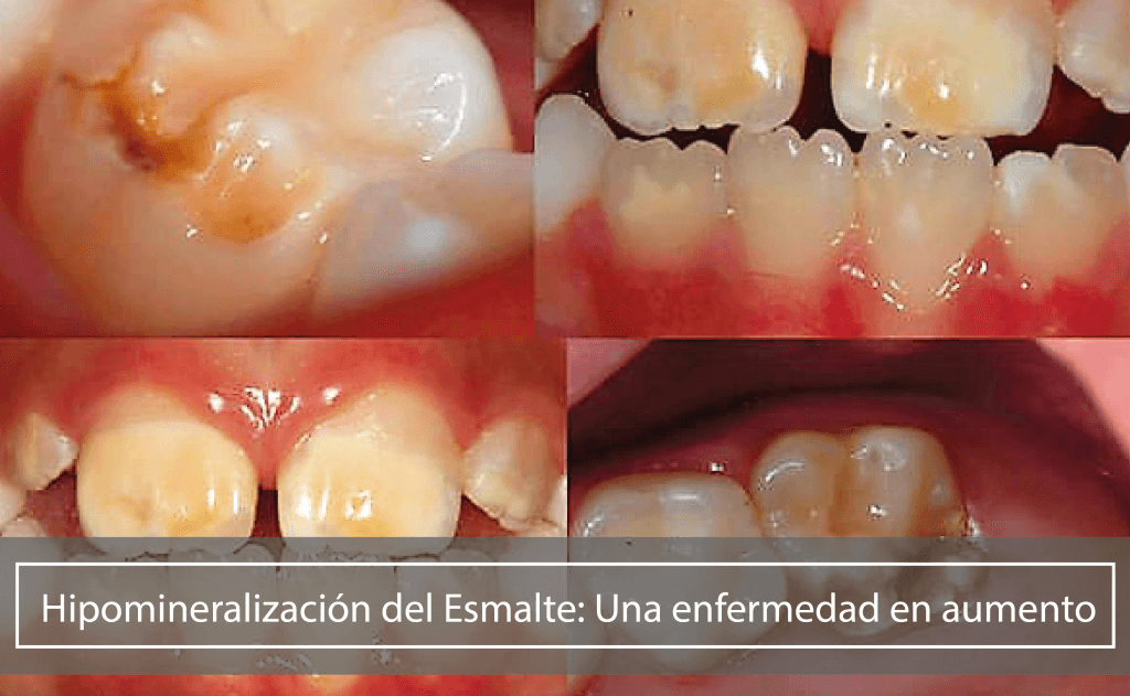Hipomineralizacion