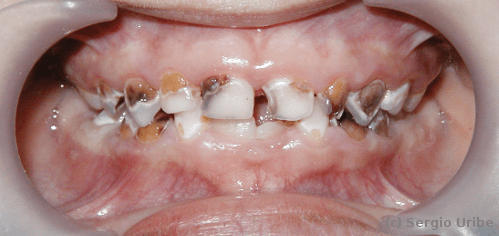 Caries del biberon