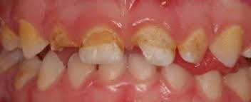 Caries del Biberón