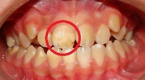 hipomineralizacion_en_esmalte_de_incisivos_y_molares