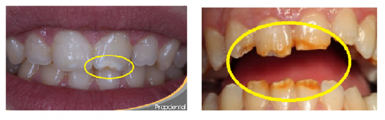 ¿Cómo Saber Si Mi Hijo Tiene Hipoplasia Dental? | Dentilandia