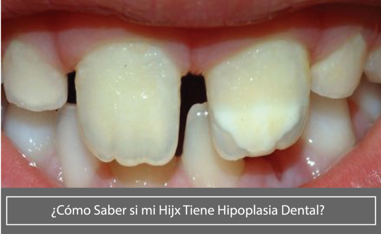 Hipoplasia Dental