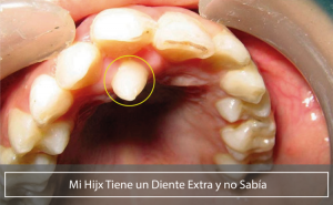 Diente extra en la boca de un niño